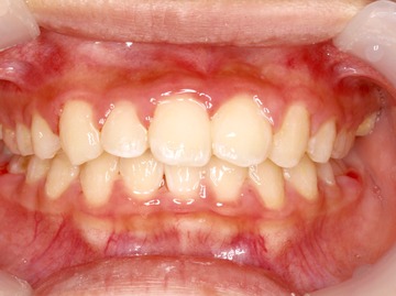 ケースNo.2 治療後 (1).jpg